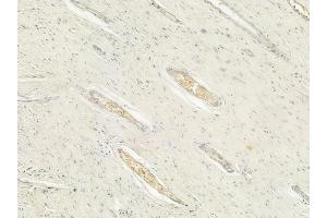 ABIN6260673 and ABIN6276631 at 1/100 staining human pancreatic carcinoma by IHC-P. (CDC20 anticorps  (N-Term))