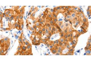 Immunohistochemistry of paraffin-embedded Human lung cancer tissue using GLUT-4 Polyclonal Antibody at dilution 1:70 (GLUT4 anticorps)