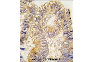 Formalin-fixed and paraffin-embedded human colon carcinoma tissue reacted with CLIC5 antibody , which was peroxidase-conjugated to the secondary antibody, followed by DAB staining. (CLIC5 anticorps)