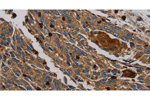 Immunohistochemistry of paraffin-embedded Human lung cancer tissue using PER2 Polyclonal Antibody at dilution 1:50