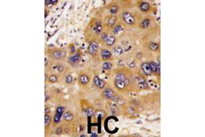 Formalin-fixed and paraffin-embedded human hepatocellular carcinoma tissue reacted with HNMT polyclonal antibody , which was peroxidase-conjugated to the secondary antibody, followed by DAB staining.
