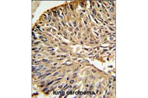 DHFR Antibody IHC analysis in formalin fixed and paraffin embedded human lung carcinoma followed by peroxidase conjugation of the secondary antibody and DAB staining. (Helical Factor anticorps  (C-Term))