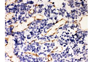 Anti- Hsp47 Picoband antibody, IHC(P) IHC(P): Human Lung Cancer Tissue (SERPINH1 anticorps  (AA 247-418))