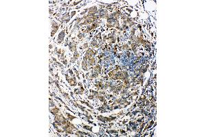Anti-Bag3 antibody, IHC(P) IHC(P): Human Mammary Cancer Tissue