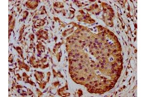 IHC image of ABIN7166183 diluted at 1:400 and staining in paraffin-embedded human pancreatic cancer performed on a Leica BondTM system.