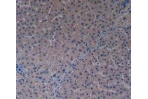 IHC-P analysis of Human Liver Cancer Tissue, with DAB staining. (PAK1 anticorps  (AA 252-501))