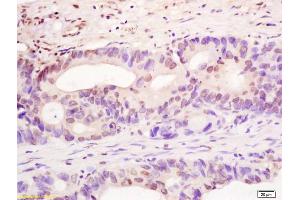 Formalin-fixed and paraffin embedded human colon carcinoma labeled with Rabbit Anti YBX-1/YB1 Polyclonal Antibody, Unconjugated (ABIN759851) at 1:200 followed by conjugation to the secondary antibody and DAB staining