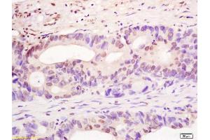 Formalin-fixed and paraffin embedded human colon carcinoma labeled with Rabbit Anti YBX-1/YB1 Polyclonal Antibody, Unconjugated (ABIN759851) at 1:200 followed by conjugation to the secondary antibody and DAB staining (YBX1 anticorps)