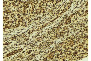 ABIN6274181 at 1/100 staining Human breast cancer tissue by IHC-P.