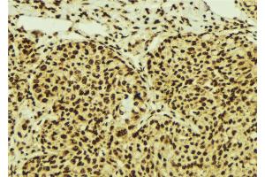 ABIN6274549 at 1/100 staining Human breast cancer tissue by IHC-P. (ZNF148 anticorps  (N-Term))