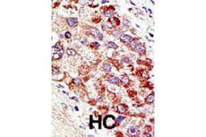 Formalin-fixed and paraffin-embedded human hepatocellular carcinoma tissue reacted with CBLC polyclonal antibody  , which was peroxidase-conjugated to the secondary antibody, followed by AEC staining. (CBLC anticorps  (N-Term))
