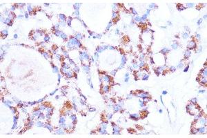 Immunohistochemistry of paraffin-embedded Human thyroid cancer using ISG15 Polyclonal Antibody at dilution of 1:100 (40x lens).