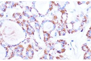 Immunohistochemistry of paraffin-embedded Human thyroid cancer using ISG15 Polyclonal Antibody at dilution of 1:100 (40x lens). (ISG15 anticorps)