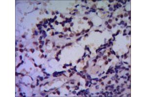 Immunohistochemical analysis of paraffin-embedded human breast cancer using HSPA4 monoclonal antibody, clone 5A6  with DAB staining. (HSPA4 anticorps)
