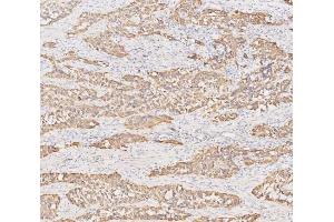 IHC analysis of Cytokeratin 19 using anti-Cytokeratin 19 antibody (ABIN3043288).