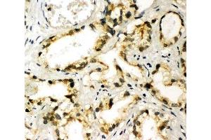 IHC-P: TBK1 antibody testing of human prostate cancer tissue (TBK1 anticorps  (C-Term))