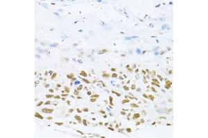 Immunohistochemistry of paraffin-embedded human lung cancer using DNMT1 antibody (ABIN5973205) at dilution of 1/100 (40x lens). (DNMT1 anticorps)