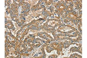 The image on the left is immunohistochemistry of paraffin-embedded Human thyroid cancer tissue using ABIN7190392(CWC27 Antibody) at dilution 1/40, on the right is treated with synthetic peptide. (Cwc27 anticorps)