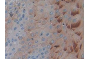 Detection of PTPRH in Human Stomach cancer Tissue using Polyclonal Antibody to Protein Tyrosine Phosphatase Receptor Type H (PTPRH)