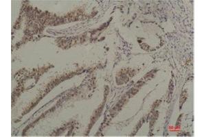 Immunohistochemistry (IHC) analysis of paraffin-embedded Human Breast Carcicnoma using HSC70 Mouse Monoclonal Antibody diluted at 1:200.
