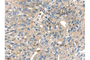 The image on the left is immunohistochemistry of paraffin-embedded Human breast cancer tissue using ABIN7192372(SIGLEC8 Antibody) at dilution 1/25, on the right is treated with synthetic peptide. (SIGLEC8 anticorps)