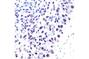 Immunohistochemistry of paraffin-embedded human esophageal cancer using 53BP1 Rabbit mAb (ABIN1679832, ABIN3018199, ABIN3018200 and ABIN7101582) at dilution of 1:100 (40x lens). (TP53BP1 anticorps)