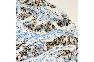 Immunohistochemical analysis of RRS1 staining in human colon cancer formalin fixed paraffin embedded tissue section.