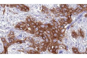 ABIN6277066 at 1/100 staining Human Head and neck cancer tissue by IHC-P. (GNA15 anticorps  (C-Term))
