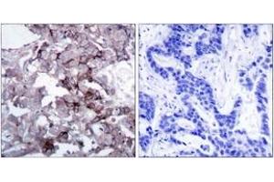 Immunohistochemistry analysis of paraffin-embedded human breast carcinoma tissue, using EGFR (Ab-1172) Antibody. (EGFR anticorps  (AA 1139-1188))