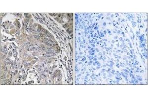 Immunohistochemistry analysis of paraffin-embedded human lung carcinoma, using SPINK6 Antibody.