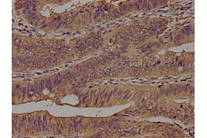 IHC image of ABIN7160185 diluted at 1:100 and staining in paraffin-embedded human colon cancer performed on a Leica BondTM system.