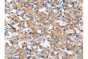 The image is immunohistochemistry of paraffin-embedded human thyroid cancer tissue using ABIN7129101(CUL7 Antibody) at dilution 1/35. (Cullin 7 anticorps)