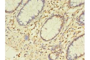 Immunohistochemistry of paraffin-embedded human colon cancer using ABIN7163017 at dilution of 1:100