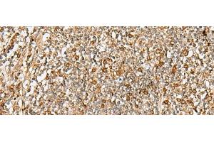 Immunohistochemistry of paraffin-embedded Human tonsil tissue using DTYMK Polyclonal Antibody at dilution of 1:70(x200)