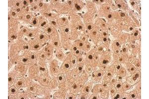 IHC-P Image Transaldolase antibody detects TALDO1 protein at nucleus on human hepatoma by immunohistochemical analysis.