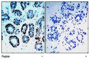 Immunohistochemical analysis of paraffin-embedded human breast carcinoma tissue, using Bsx polyclonal antibody . (BSX anticorps  (N-Term))