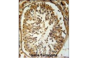 SRAC1 Antibody (C-term) (ABIN654755 and ABIN2844439) immunohistochemistry analysis in formalin fixed and paraffin embedded human testis carcinoma followed by peroxidase conjugation of the secondary antibody and DAB staining. (SERAC1 anticorps  (C-Term))