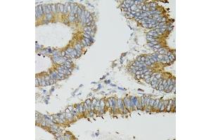 Immunohistochemistry of paraffin-embedded human colon carcinoma using MT-ND5 antibody (ABIN6135116, ABIN6144435, ABIN6144437 and ABIN6224158) at dilution of 1:100 (40x lens).