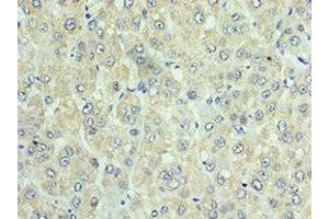 Immunohistochemistry of paraffin-embedded human liver cancer using ABIN7150549 at dilution of 1:100