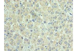 Immunohistochemistry of paraffin-embedded human liver cancer using ABIN7150549 at dilution of 1:100