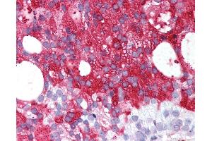 Anti-RXFP1/ LGR7 antibody IHC of human Prostate, Carcinoma. (RXFP1 anticorps  (C-Term))