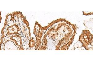 Immunohistochemistry of paraffin-embedded Human thyroid cancer tissue using GRASP Polyclonal Antibody at dilution of 1:150(x200) (Tamalin/GRASP anticorps)