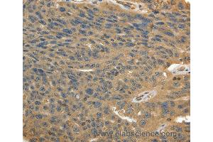 Immunohistochemistry of Human ovarian cancer using MSN Polyclonal Antibody at dilution of 1:30 (Moesin anticorps)