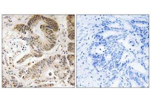 Immunohistochemistry analysis of paraffin-embedded human colon carcinoma tissue using PIK3R5 antibody. (PIK3R5 anticorps  (C-Term))