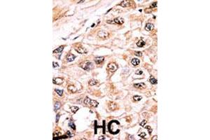Formalin-fixed and paraffin-embedded human hepatocellular carcinoma tissue reacted with ACVR1 polyclonal antibody  , which was peroxidase-conjugated to the secondary antibody, followed by AEC staining. (ACVR1 anticorps  (Internal Region))