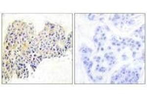 Immunohistochemical analysis of paraffin-embedded human breast carcinoma tissue using HSP90B (Ab-254) antibody.