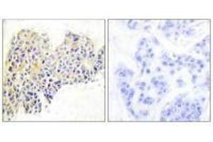 Immunohistochemical analysis of paraffin-embedded human breast carcinoma tissue using HSP90B (Ab-254) antibody. (HSP9AB1 (Ser254) anticorps)
