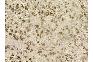 ABIN6261345 and ABIN6277187 at 1/100 staining human melanoma by IHC-P.