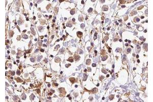 ABIN6279656 at 1/100 staining Human breast cancer tissue by IHC-P. (PIGP anticorps)