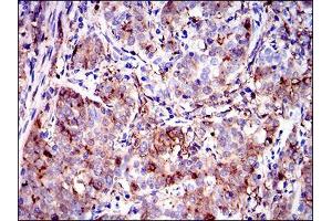 Immunohistochemical analysis of paraffin-embedded cervical cancer tissues using ANXA1 mouse mAb with DAB staining. (Annexin a1 anticorps  (AA 144-248))